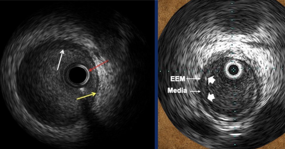 ivus medizin